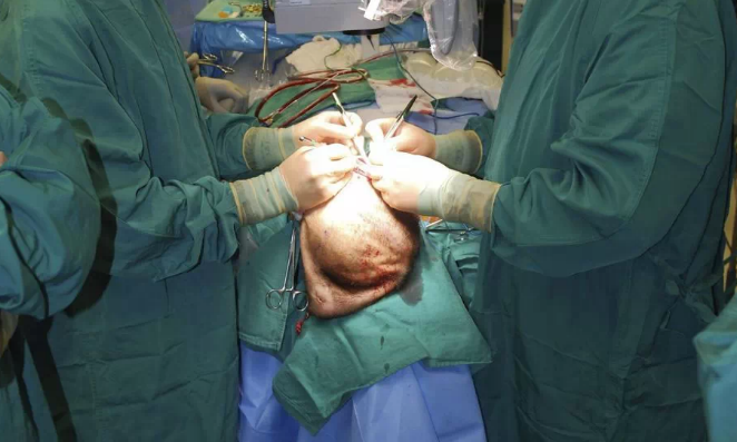 Extirpan tumor 36 veces mayor a un riñón el chiltepin